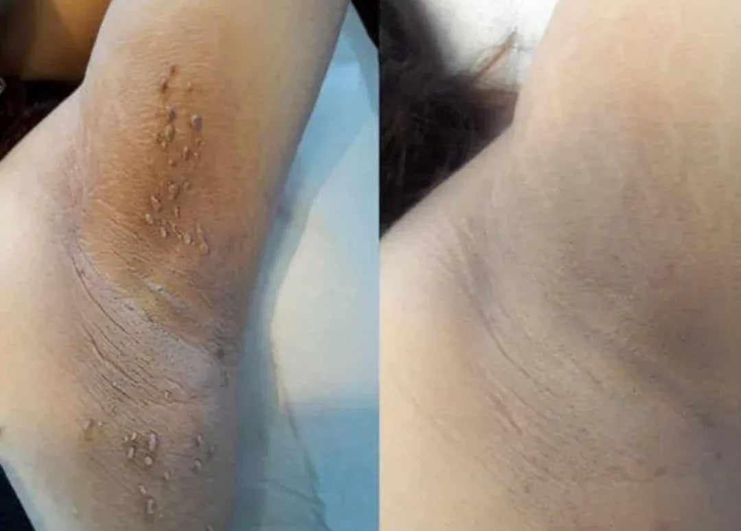 ChillErase Bump Renewal Spray