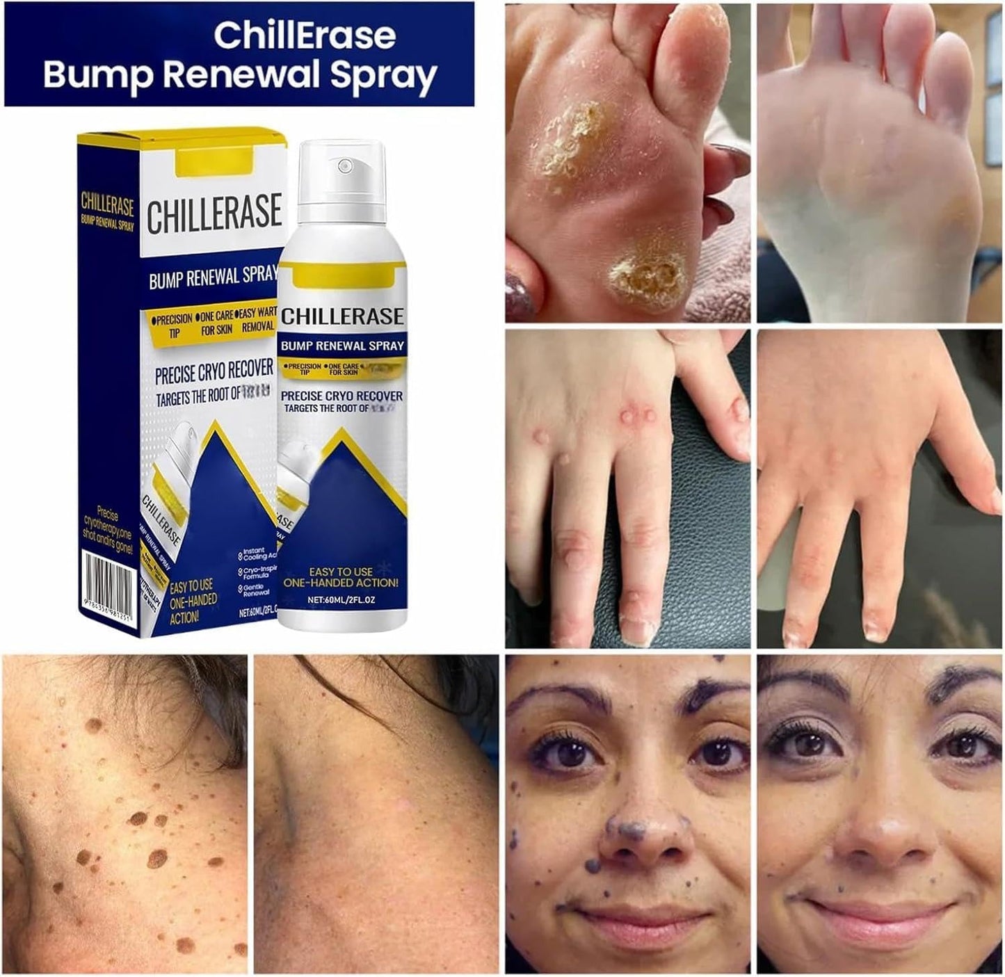 ChillErase Bump Renewal Spray